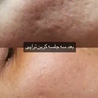 لیزر تتو وروشن کننده بدن|خدمات آرایشگری و زیبایی|پاکدشت, پاکدشت (مامازند)|دیوار