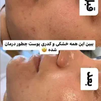 فشیال و پاکسازی جوانسازی فقط۵۰۰ الی ۵۵۰ فول دستگاه|خدمات آرایشگری و زیبایی|شاهین‌شهر, عطار|دیوار
