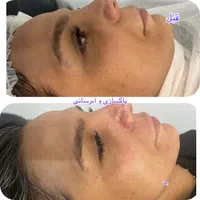 فیشال و نخ کلاژن به جای بوتاکس|خدمات آرایشگری و زیبایی|اصفهان, کوی ولی عصر|دیوار