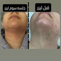 لیزر مو زائد تضمینی