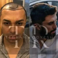 جشنواره کاشت مو یک روزه فول تراکم|خدمات آرایشگری و زیبایی|تهران, دزاشیب|دیوار