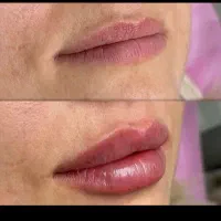 انواع کارا زیبایی ژل بوتاکس فیلر بیکنی فیلر بادی