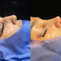 عمل بینی ۲۰ تومن ابدو ساکشن اسلیو  لیفت شقیقه رینو