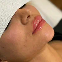 تزریق ژل بوتاکس مزوتراپی پاکسازی جوانسازی|خدمات آرایشگری و زیبایی|تهران, نیروی هوایی (پیروزی)|دیوار