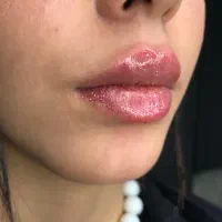 تخفیفات ویژه خدمات فیلر و بوتاکس صورت