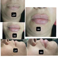 بوتاکس جوانساز آنزیم فیلر|خدمات آرایشگری و زیبایی|ملایر, |دیوار