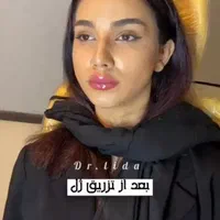 ژل لب بوتاکس فیلر انزیم ساکشن غبغب گونه زاویه سازی|خدمات آرایشگری و زیبایی|مشهد, سجاد شهر|دیوار