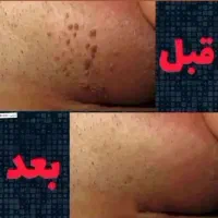 رفع دائمی زگیل و تبخال تناسلی|آرایشی، بهداشتی، درمانی|شیراز, شهرک گلها|دیوار