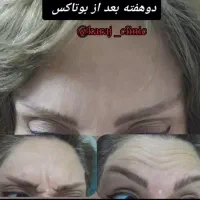 جشنواره ژل لب فیلر زیرچشم بوتاکس،هایفوکلینیک معتبر|خدمات آرایشگری و زیبایی|کرج, گوهردشت|دیوار