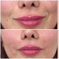تزریق و آموزش بوتاکس و ژل و پرسینگ و مزو و غیره