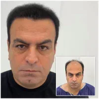 کاشت مو تخصصی vip کار شیرازی،۱۰۰ درصد تضمینی|خدمات آرایشگری و زیبایی|یزد, |دیوار