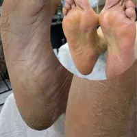 پدیکور پاتخصصی فقط ۳۰۰به مدت یه هفته