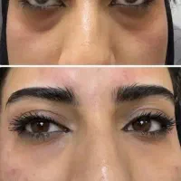 جشنواره پک مادلینگ +بوتاکس رایگان(فک لب گونه چانه)|خدمات آرایشگری و زیبایی|قم, زنبیل آباد|دیوار