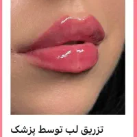 تخفیفات طلایی/ژل لب/ بوتاکس/ گونه/ فول فیس خط خنده|خدمات آرایشگری و زیبایی|مشهد, دانشجو|دیوار