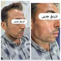 ساکشن غبغب تزریق چربی ۲م فقط پنجشنبه و جمعه|خدمات آرایشگری و زیبایی|اهواز, امانیه|دیوار