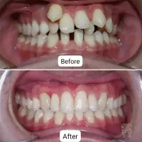 ارتودنسی با تخفیف10میلیون تومانی‌/اقساط بلندمدت