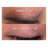 ریموو(پاک کردن تاتو) صورت وبدن با لیزر پیشرفته|خدمات آرایشگری و زیبایی|تبریز, |دیوار