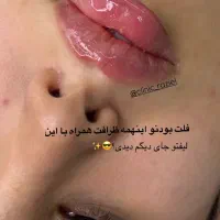 تخفیفات استثنایی ژل و بوتاکس در مطب زیبایی|خدمات آرایشگری و زیبایی|قم, دورشهر|دیوار