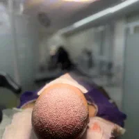 کاشت تخصصی مو در شیراز