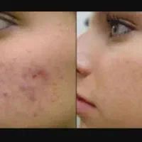 میکرونیدلینگ تخصصی