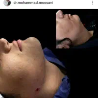 ژل .بوتاکس .هایفو.ساکشن غبغب وساکشن شکم وپهلو|خدمات آرایشگری و زیبایی|اصفهان, رکن الدوله غربی|دیوار