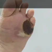 بهبودی دیابت بدونه نیاز به قرص رفع مشکلات جنسی
