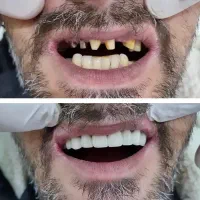 مرکز روکش دندان و کامپوزیت