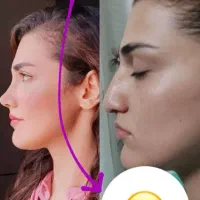 جراحی زیبایی بینی در جشنواره 32تومن