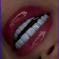 ترمیم روکش دندان ونیر جرمگیری کامپوزیت لیفت لثه