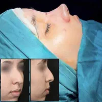 زیبایی بینی با سه ماه تنفس درشروع قسط با سفته
