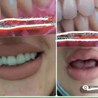 دندان سازی امین دندان مصنوعیه طرح لمینت