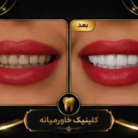 آفر ایمپلنت دندان باقیمت واقساط بلندمدت فقط یکهفته