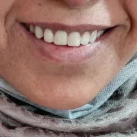 دندان مصنوعی با کیفیت به قیمت سال قبل