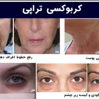 کربوکسی تراپی|خدمات آرایشگری و زیبایی|رفسنجان, |دیوار