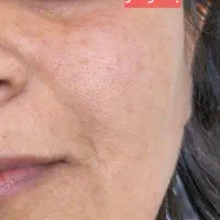 کربن تراپی صورت و بدن|خدمات آرایشگری و زیبایی|فردیس, فردیس|دیوار