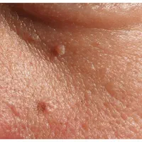 برداشت میخچه خال زگیل جراحی لیپوم لیزری توسط پزشک|خدمات آرایشگری و زیبایی|مشهد, توس (بلوار توس)|دیوار