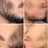 موهای پر پشته سر و صورت