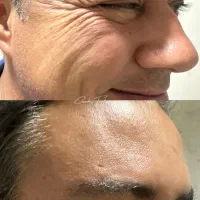 بوتاکس چشم گربه ای تضمینی پی ار اف آنزیم|خدمات آرایشگری و زیبایی|کرج, گوهردشت|دیوار