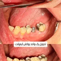 مرکز تخصصی ایمپلنت