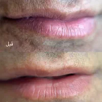 مرکز تخصصی رفع تیرگی لب و آرایش دائم