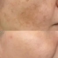 فیشیال تخصصی/پلاژن تراپی/ اسیدتراپی صورت و بدن