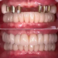 دندانپزشک اقساط کامپوزیت لمینیت لب شیشه ای بلیچینگ|خدمات آرایشگری و زیبایی|مشهد, سجاد شهر|دیوار