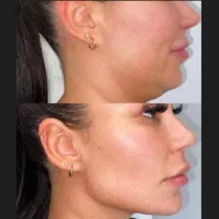 تخفیف تزریق ژل، بوتاکس در منزل|خدمات آرایشگری و زیبایی|گرگان, |دیوار