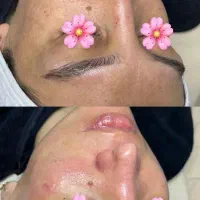 آموزش و خدمات تخصصی پاکسازی و فیشال تخصصی پوست