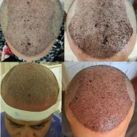 کاشت مو و ابرو|خدمات آرایشگری و زیبایی|تبریز, |دیوار