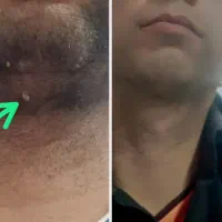 برداشتن خال زگیل و میخچه با محلول صدر صد گیاهی|آرایشی، بهداشتی، درمانی|کرمان, |دیوار