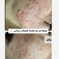 فیشال  پاکسازی پوست مدل فیشال