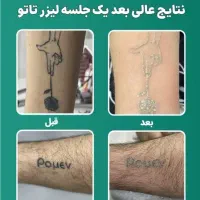 جلسه اول لیزر موهای زائد با کربن تراپی رایگان|خدمات آرایشگری و زیبایی|نجف‌آباد, شریعتی|دیوار