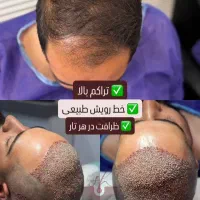 کاشت مو با تخفیفات ویژه در کلینیک تخصصی باران