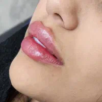 تزریق تخصصی فیلربوتاکس فیلربادی وانزیم|خدمات زیبایی و سلامت|تهران, جمهوری|دیوار